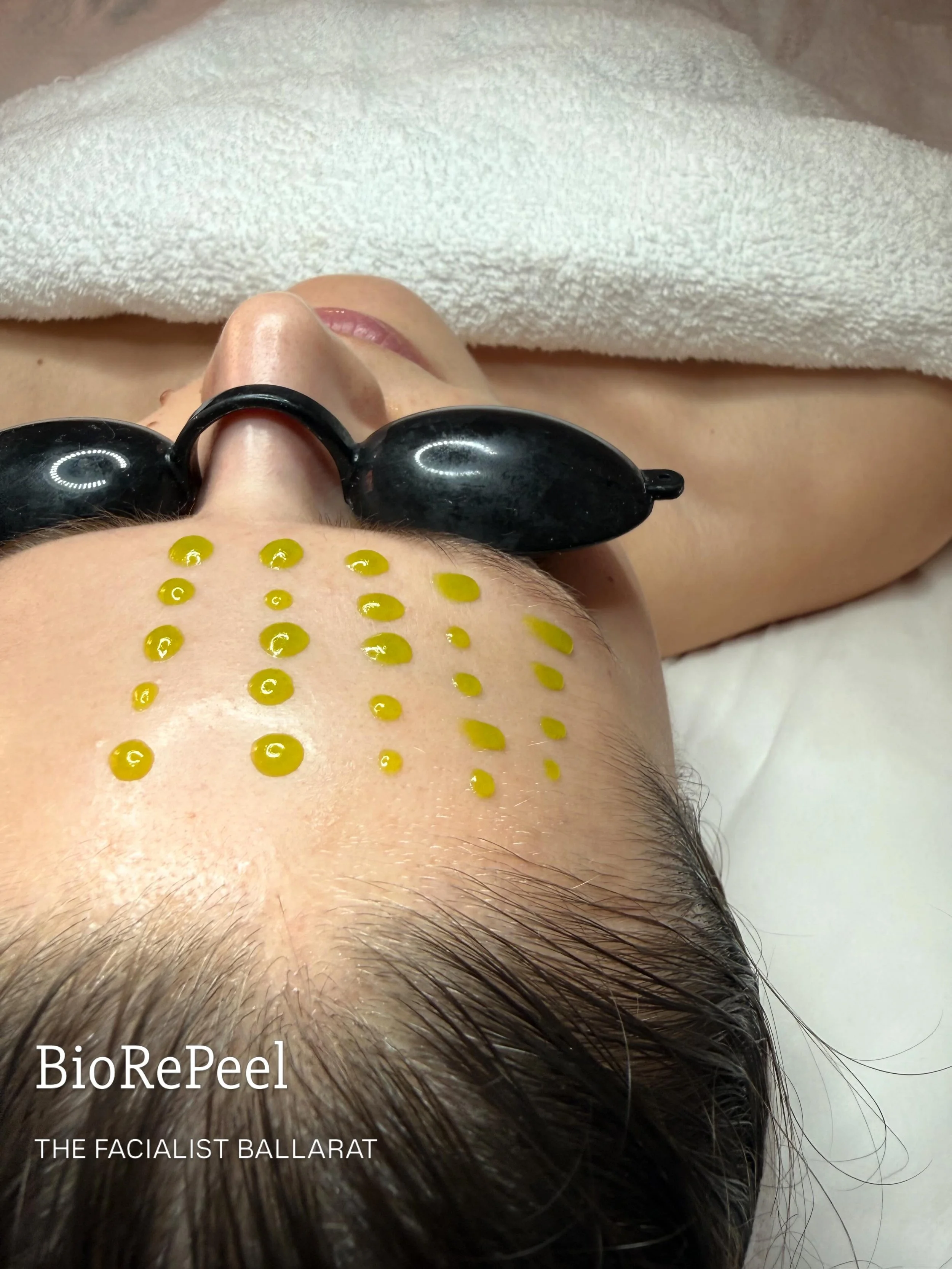 BioRePeel is an innovative peel with a unique formulation that bypasses the epidermal layer to revitalise and rejuvenate the skin from within.

We love this peel for its immediate glow, safety and little to no downtime. 

Suitable for all skin types.