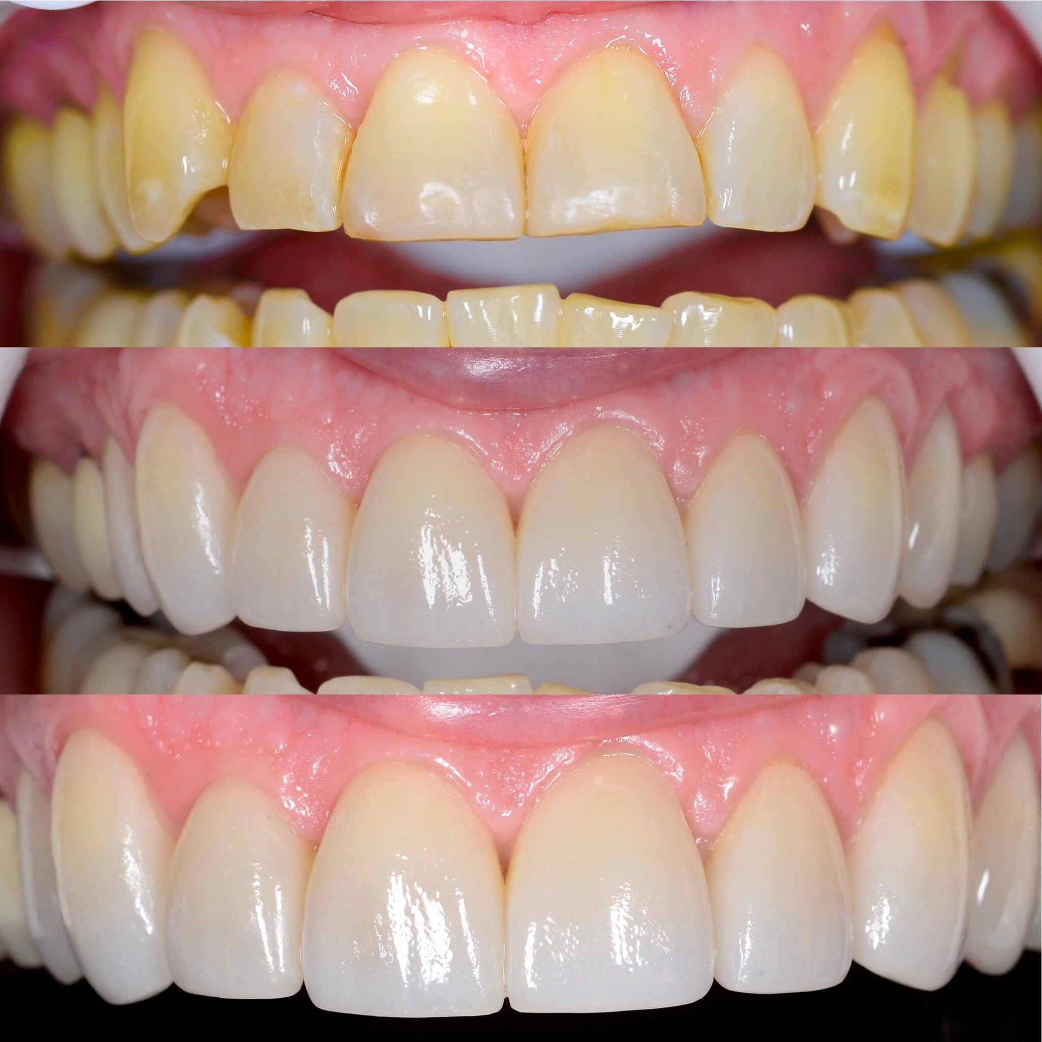 Veneers — Roots Dental Studio