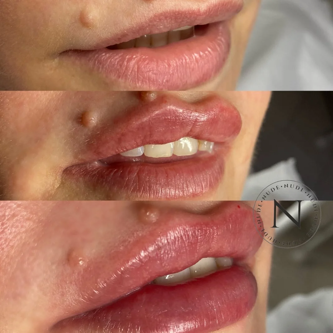 No filler ➡️ Half way done ➡️ In love. Obsessed. Can&rsquo;t look away. 

#lipfiller #lipfillerslondon #aqualyxtreatment #aqualyx #fatdissolvingtreatment #summerbody #dermalfillers #cupidsbow #volume #lipplumping #beautylondon #londonbeauty #vitamini