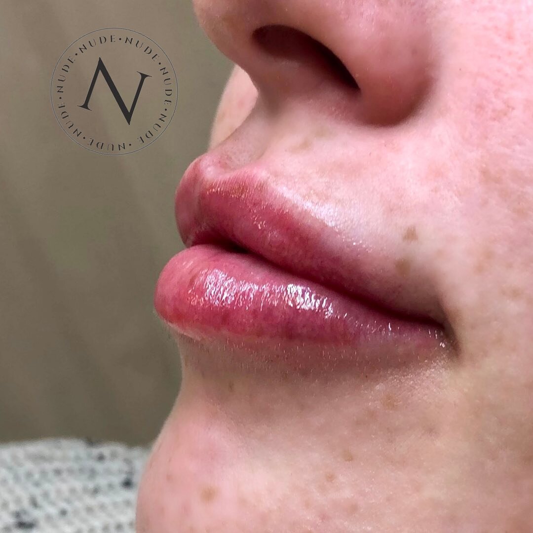 ➡️ SWIPE FOR THE BEFORE&hellip;

With lip fillers, a lot of people will immediately think &ldquo;duck lips&rdquo;. But you don&rsquo;t need to worry about that if you go to the right aesthetician! &ldquo;Duck lips&rdquo; only occur when the lips are 