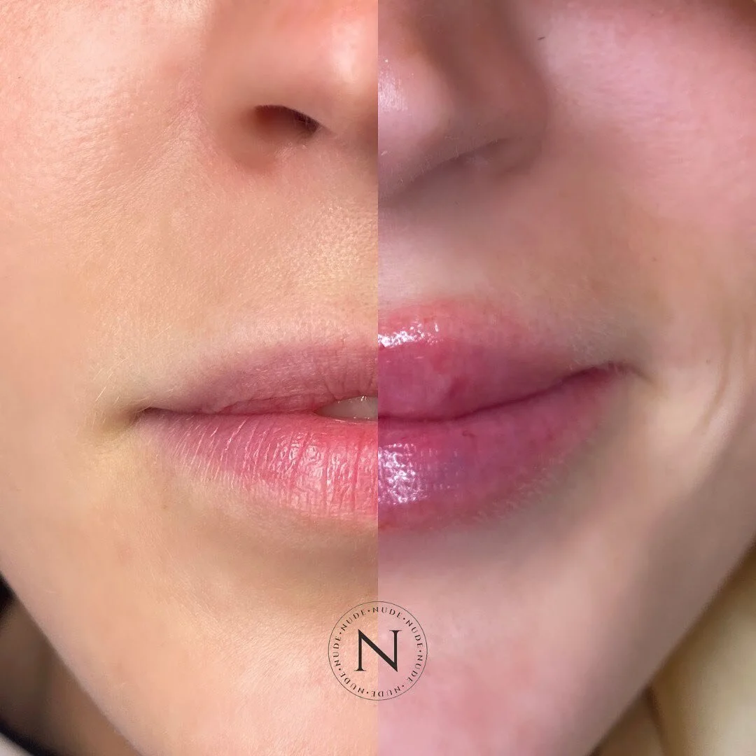 That transition though&hellip; still natural, but plumper more volumised lips. 🤍

#lipfiller #londonaesthetician #aestheticianlondon #lipfillerlondon #lipfillerslondon #lipfillers #beautysalon #londonbeautysalon #oval #kennington #southlondon #derma