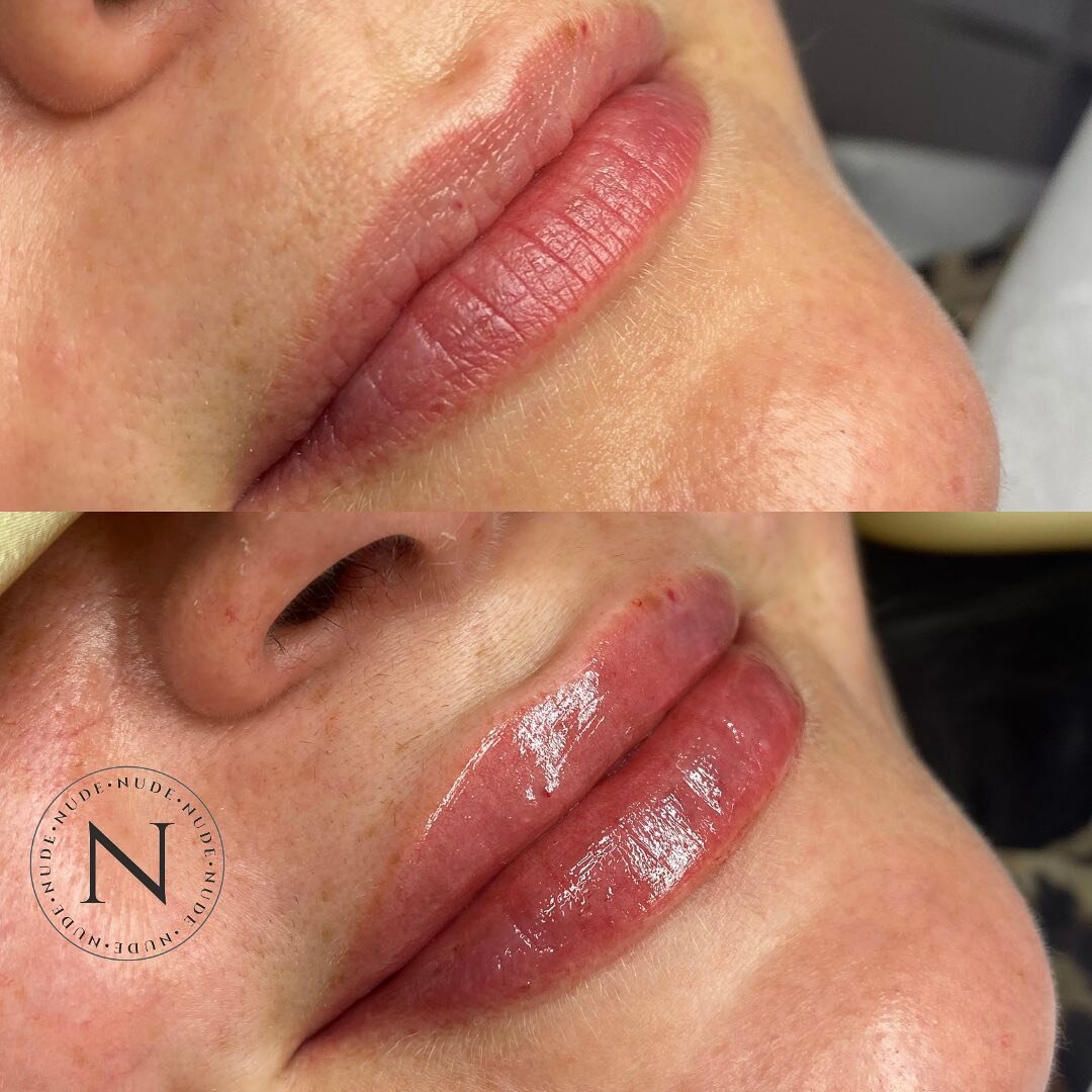 Lip fillers can look so natural if you choose the right aesthetician! We always aim to give a soft, natural finish (unless you want the big volumised wow moment lips - in which case we&rsquo;re right behind you!). 

Anti-Wrinkle 👩🏼
Dermal Filler💋
