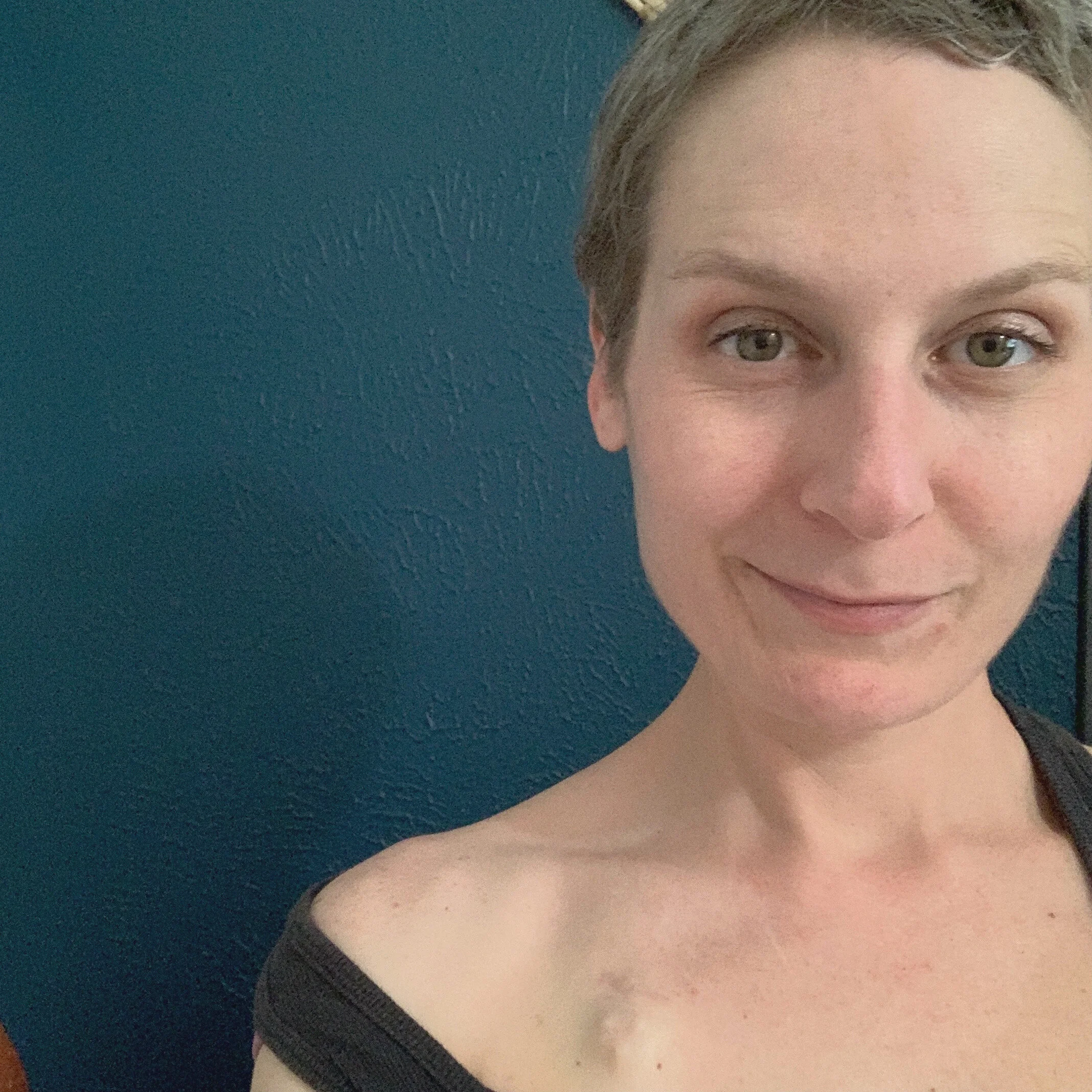 2.8.21 The last day that I had my chemo port in! Despite some doctors telling me to keep it in for a year just in case the cancer came back, I decided to have it removed after 5 months. Many reasons led me to this decision - Firstly, I BELIEVED my ca