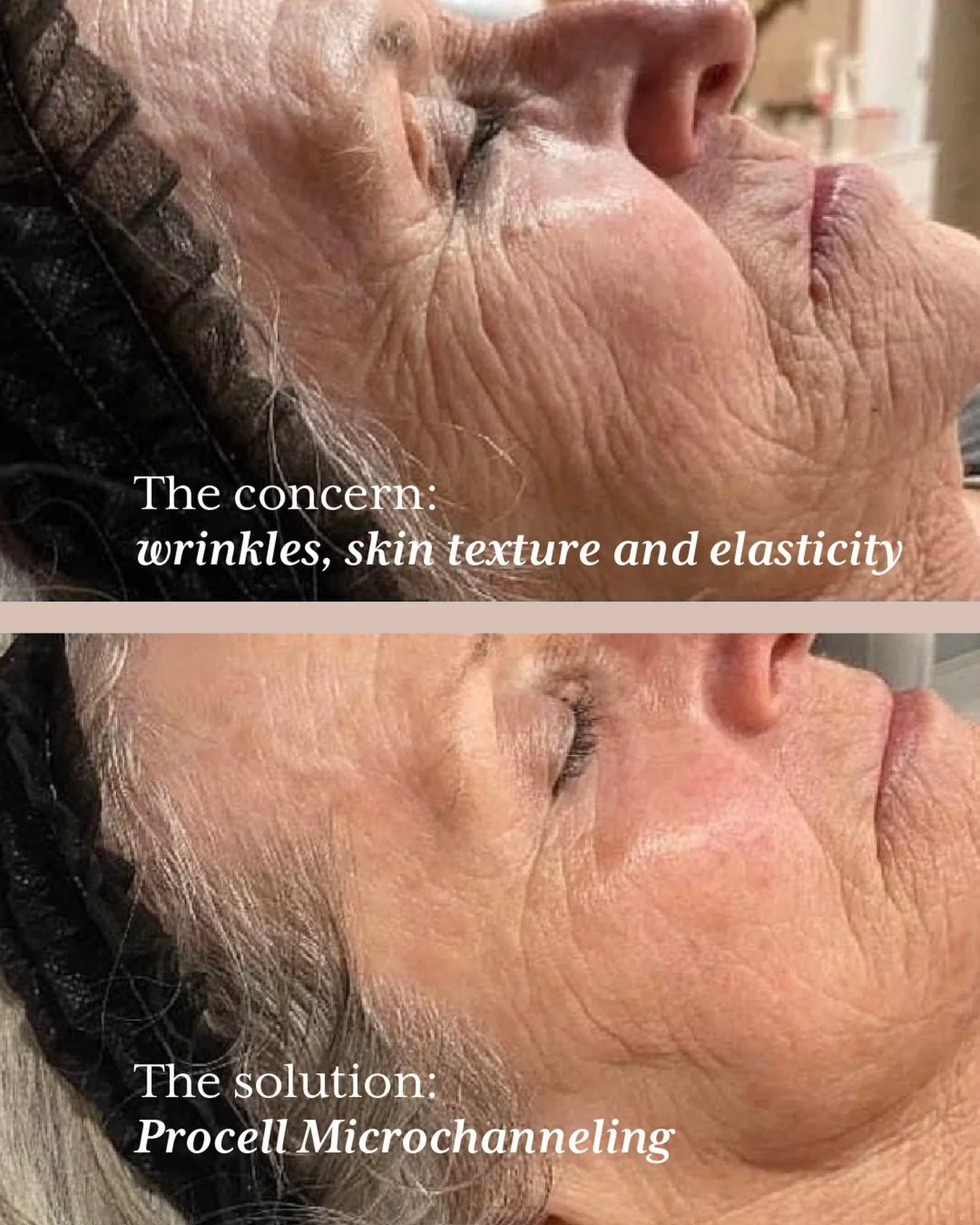 How does Procell Microchanneling work? This advanced treatment creates tiny microchannels in the skin to stimulate natural collagen production and skin renewal, helping to strengthen, smooth and refine the complexion over time. ✨

After treatment, Pr