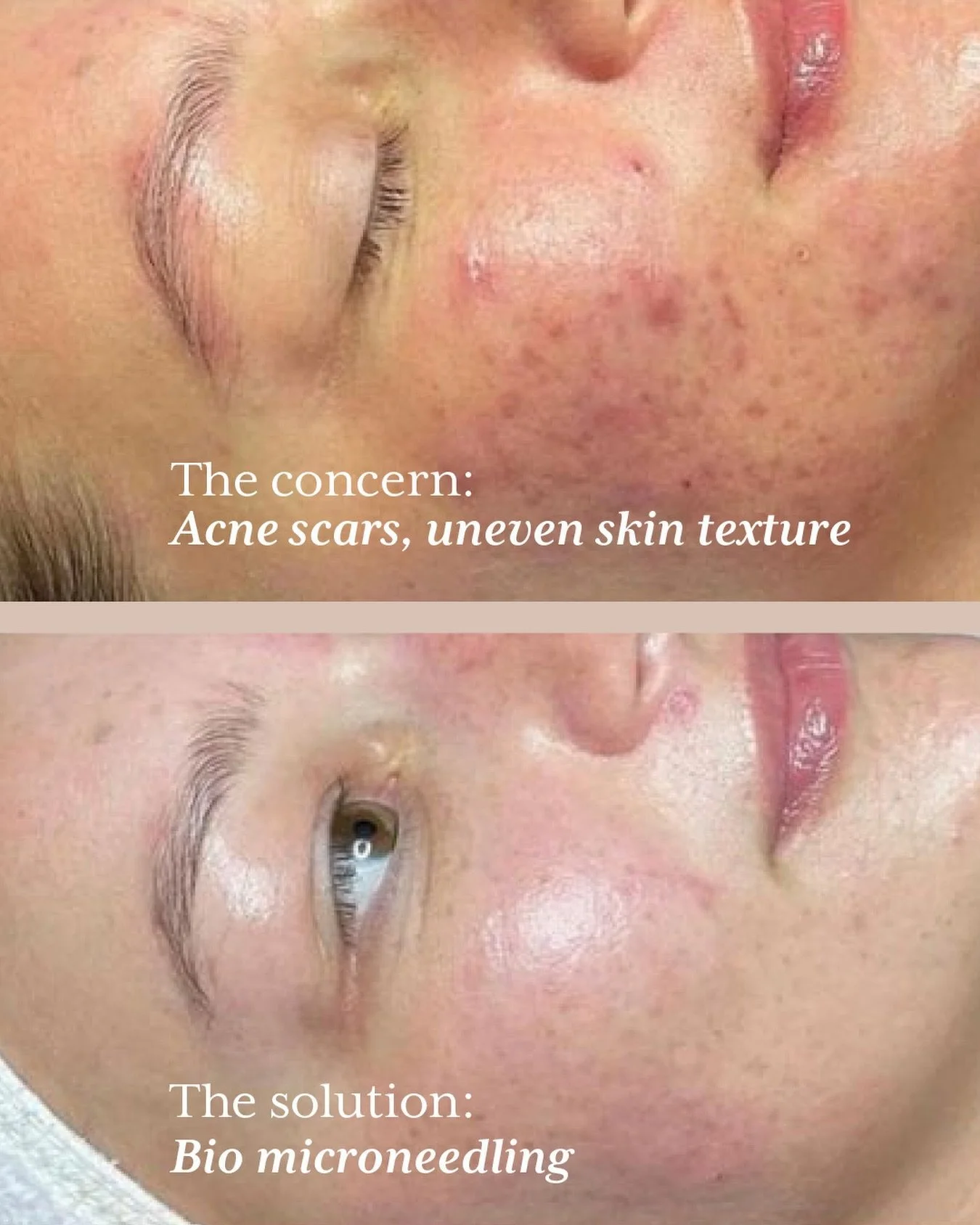 Real results! ✨ Bio microneedling helps stimulate collagen production to improve skin texture, soften fine lines, minimise acne scarring and restore glow.

Contact Skin Karma on 0418 225 202 to learn more or book a consultation. 🤍

#skinkarma #micro