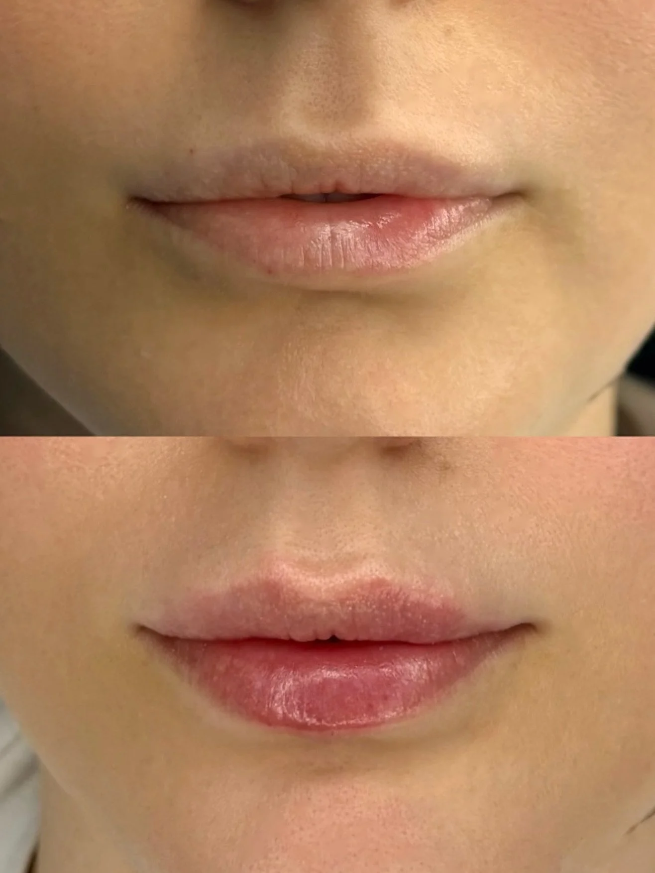 Subtle transformation of just under 0.5ml dermal filler for lips. This client wanted something really natural but to maintain the same shape. 

We came out with a really nice result!