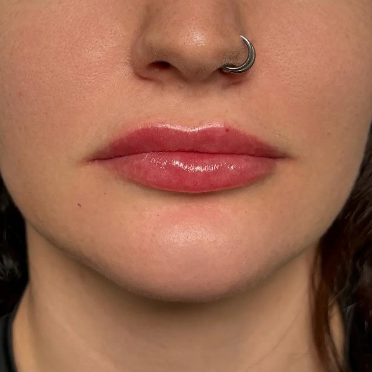 1ml Dermal Filler enhancement! 

This 1ml lip filler treatment adds gentle volume and definition while maintaining a natural shape. 

Perfect for balancing proportions, enhancing the cupid&rsquo;s bow, and giving a soft, refreshed look.