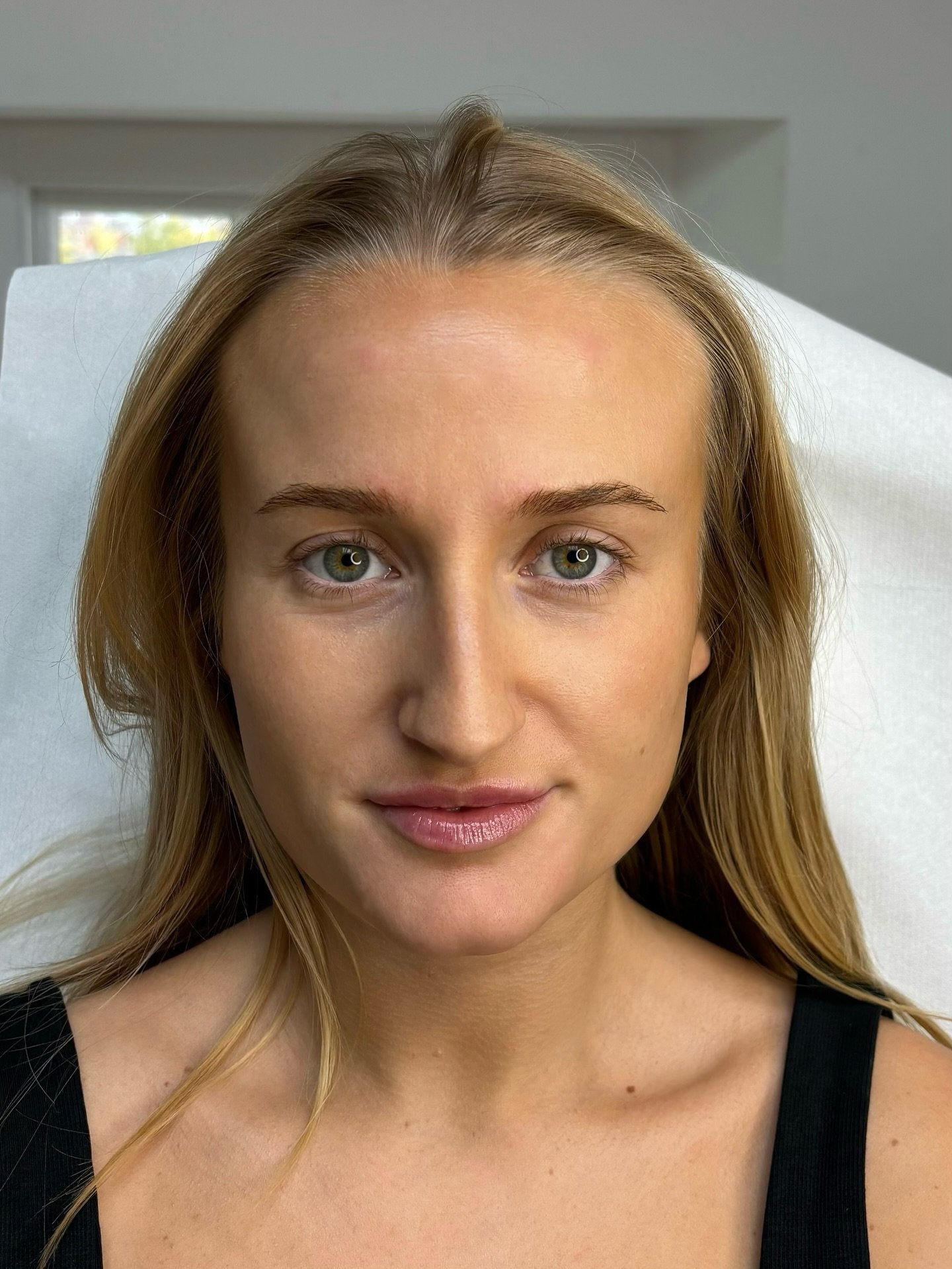 0.5ml Lip Filler &amp; 2 Areas of Anti-Wrinkle

A subtle enchantment to create balanced results, perfect for refreshing your look without overdoing it. 

Anti-wrinkle injections take around 2 weeks to show their full effect, so now is the ideal time 