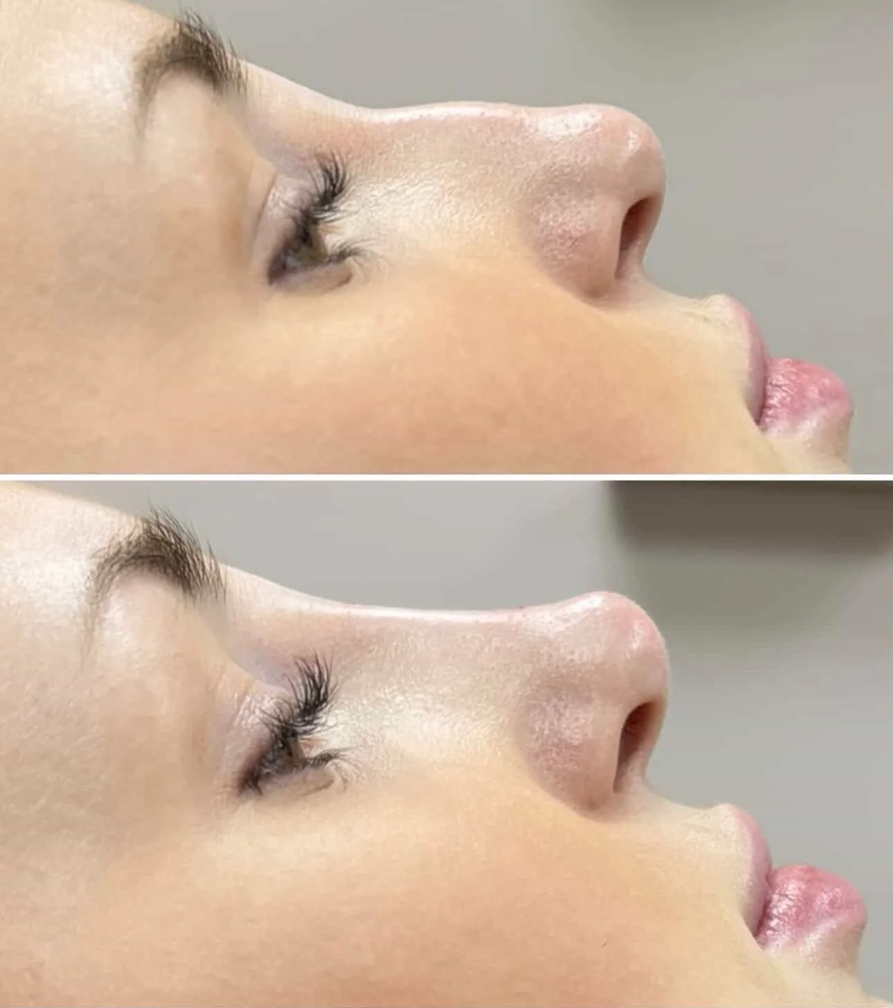 Introducing Megan a GMC Registered Practitioner who specialises in profile balancing, including her no.1 treatment - the nose. 

She has limited slots this Monday for:
Dermal Filler: (Lips, Cheeks, Nose or/ and Chin)
Anti Wrinkle Injections: Forehead