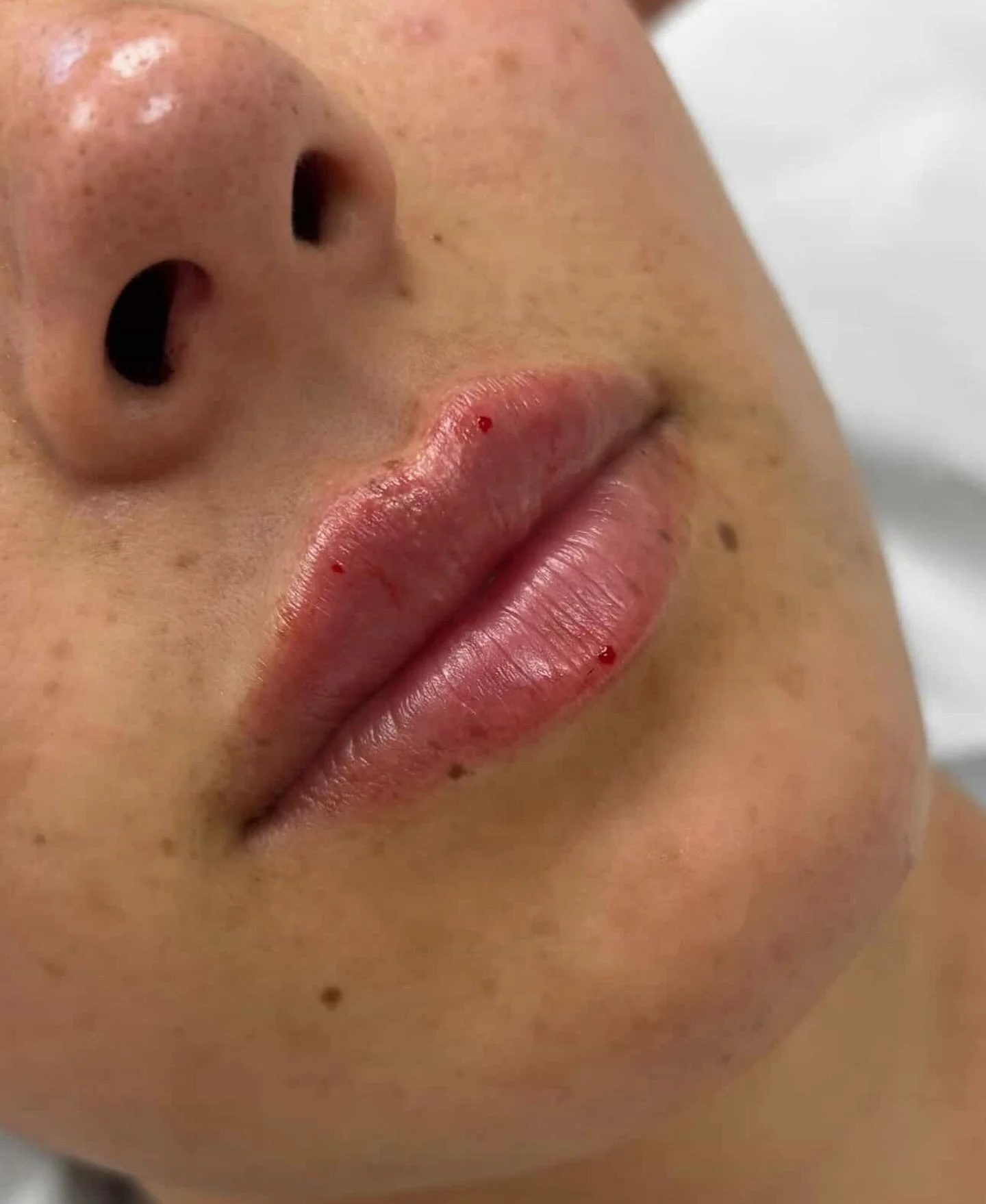 0.8ml Dermal Lip Filler💉

Appointments available on 23rd March with Megan, GMC-registered aesthetic practitioner
.
Limited availability.
Book now to secure your slot.