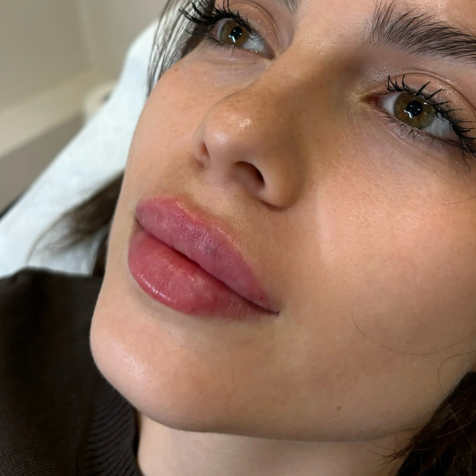 Close-up of a woman's lips being injected with cosmetic filler using a syringe, with a gloved hand holding her chin.