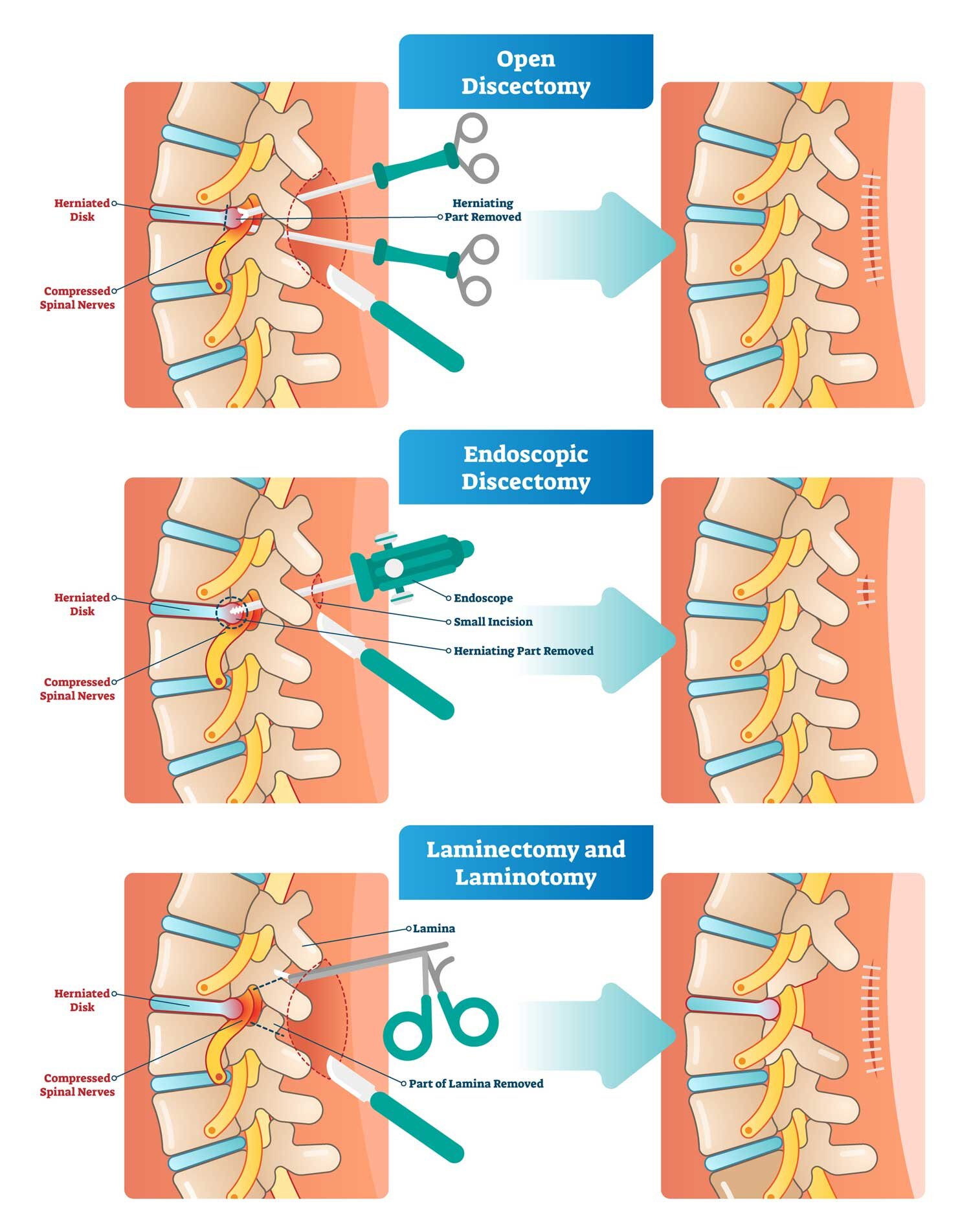Spinal Cord And Nerve Decompression — The Spine Clinic Okc
