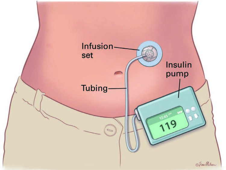 Insulin Pump.jpg