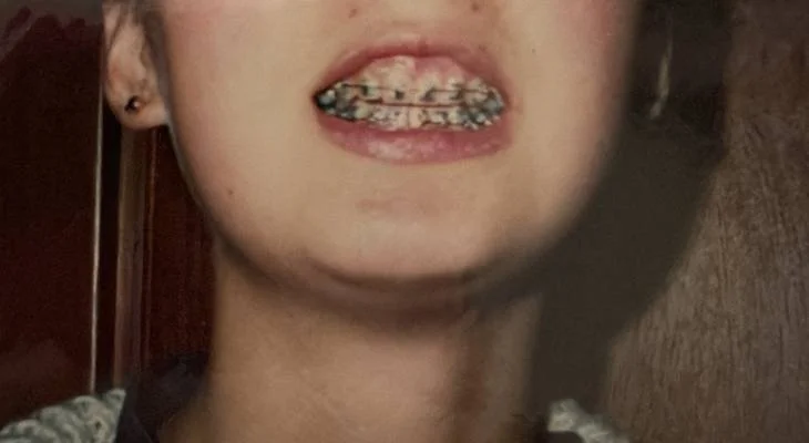 The Impact of Braces on TMJ, Jaw Alignment and the Nervous System 