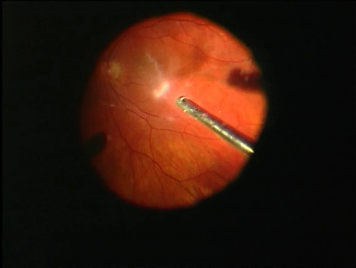 Floaters After Retinal Detachment Surgery – PMVG