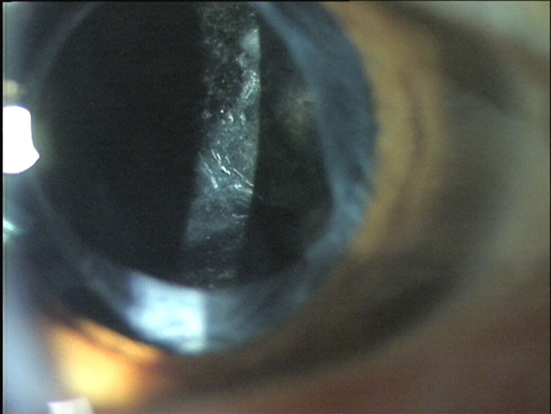 A stepwise approach for the management of capsular contraction syndrome in  hinge-based accommodative intraocular lenses - Document - Gale Academic  OneFile