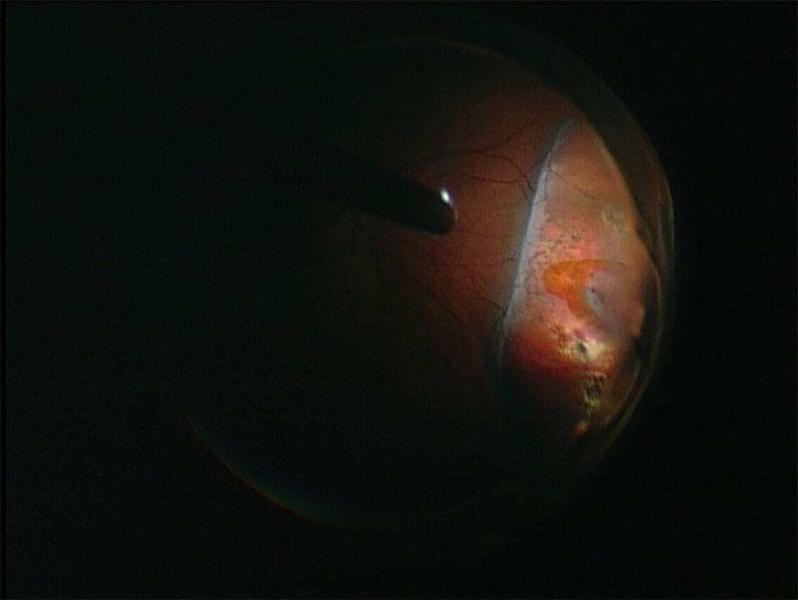 Horseshoe Tear Optos : Peripheral Retinal Degenerations and Treatment ...