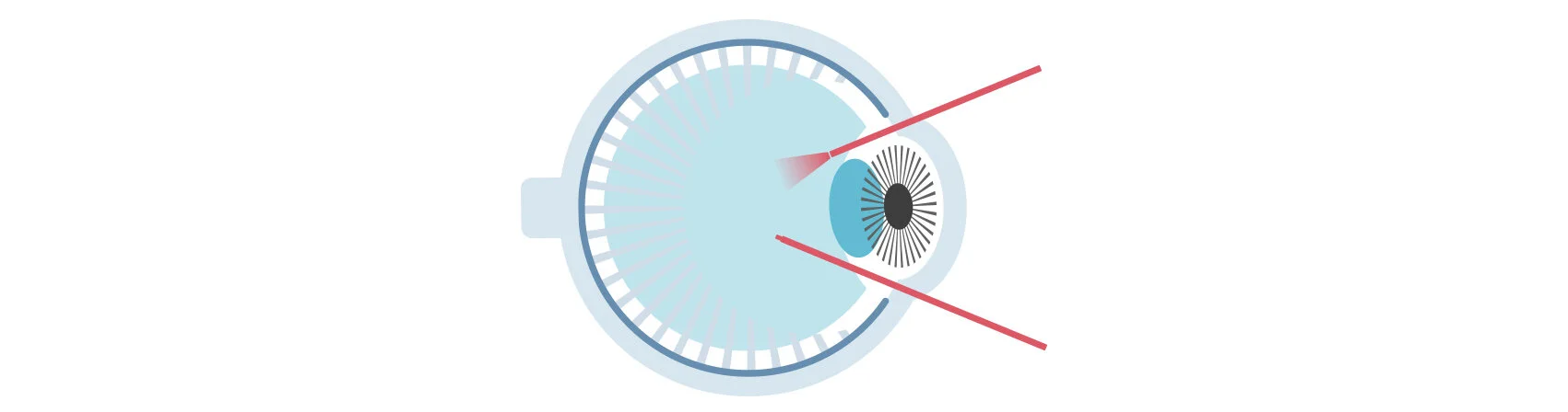 What is vitreoretinal surgery?