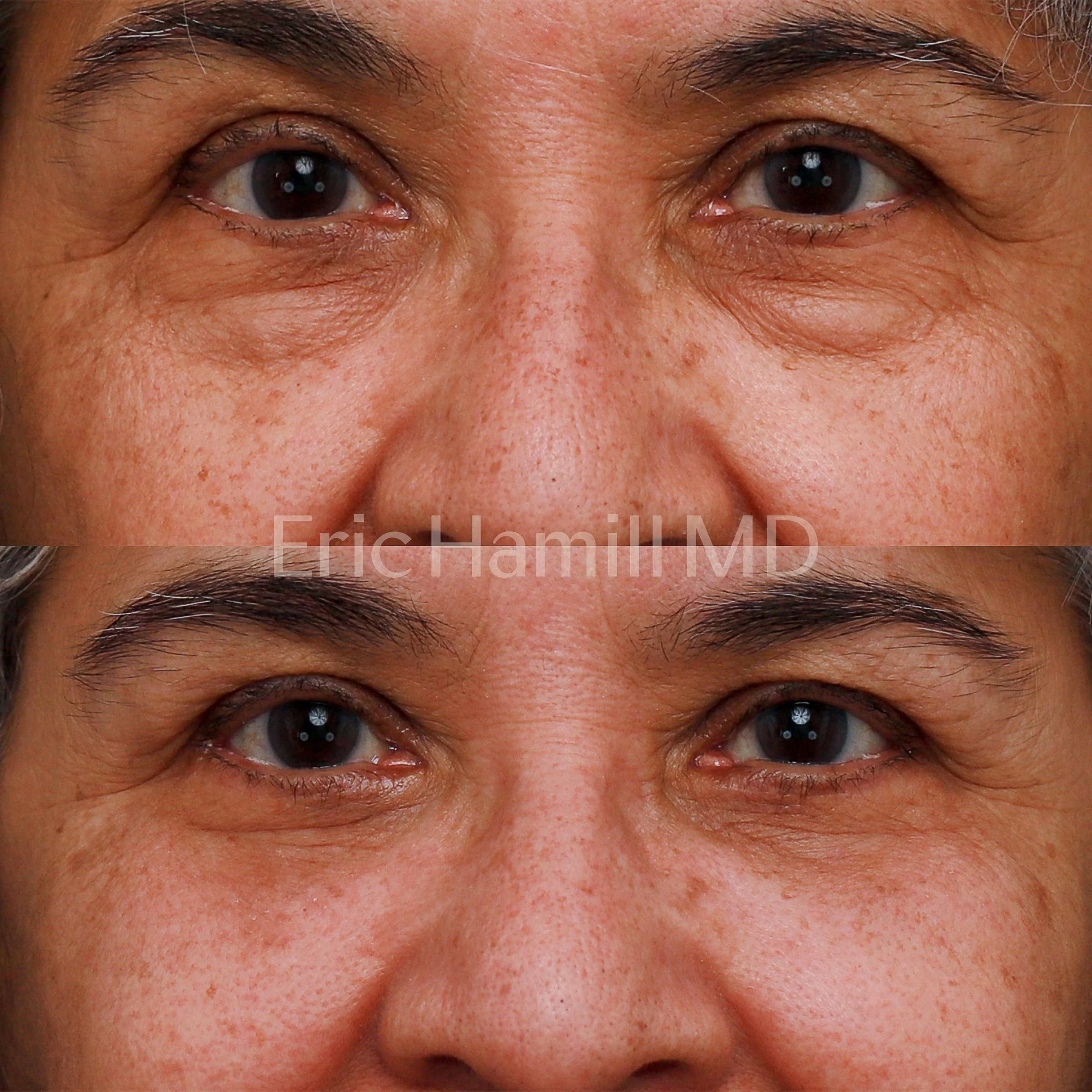 blepharoplasty-lower-transconjunctival-fat-reposition-houston-best-eyelid-lift-eric-hamill.jpg