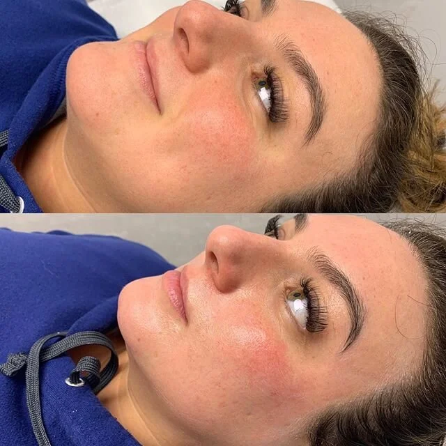 Before and after dermaplaning ✨