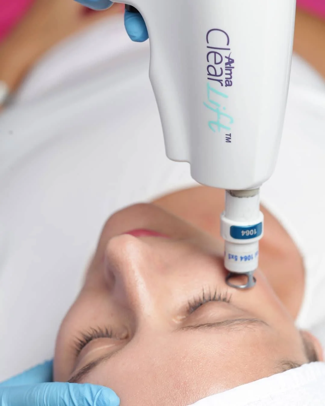 Why Non-Ablative Lasers Are Replacing Aggressive Skin Resurfacing