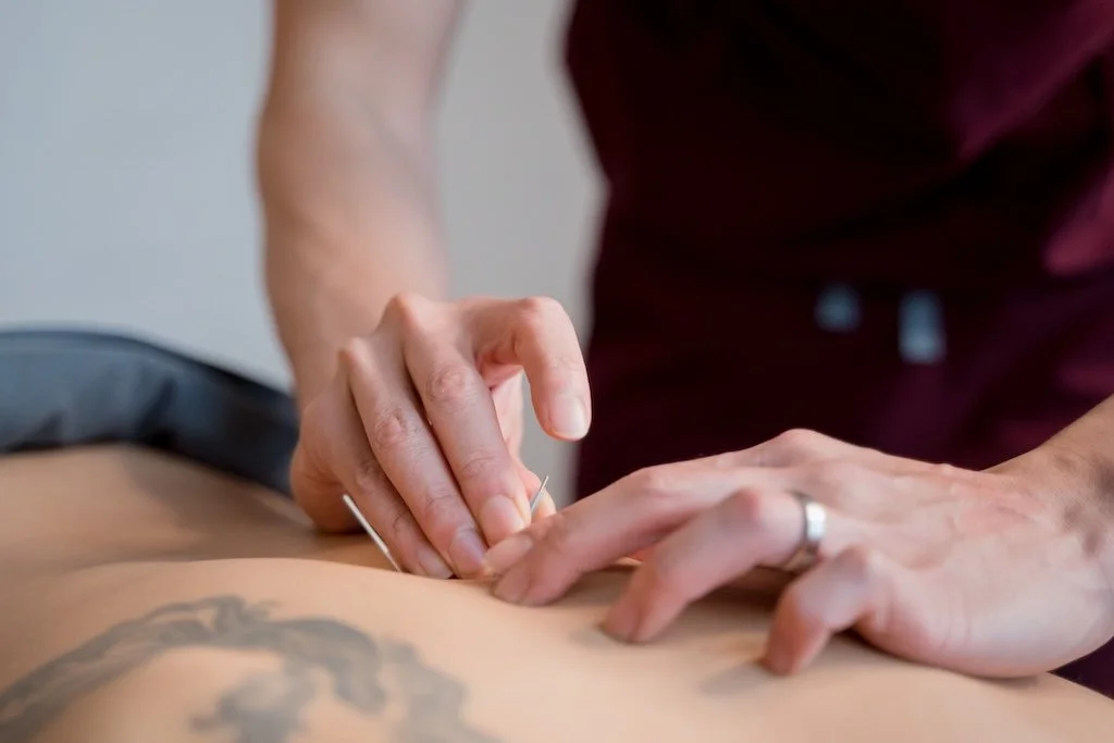 acupuncture.jpg