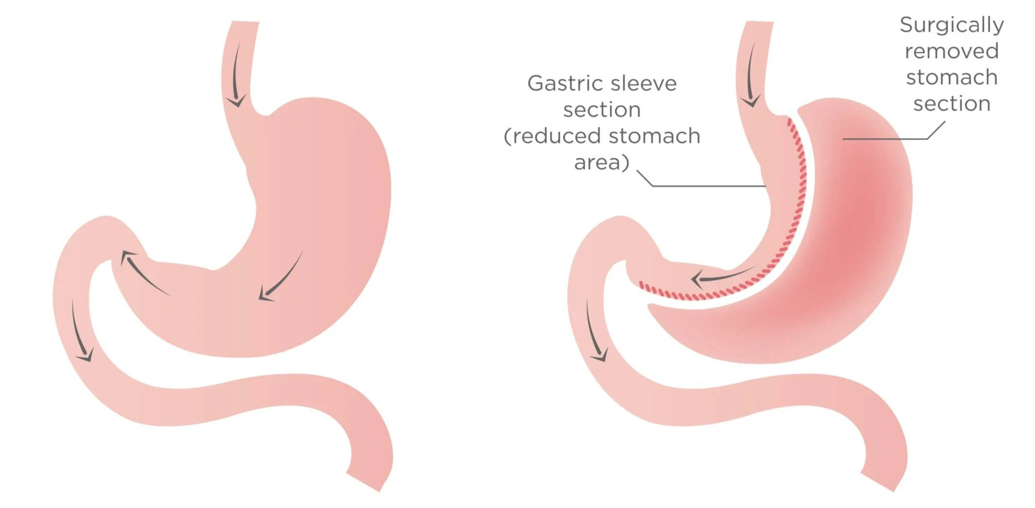 резекция желудка тюмень. резекция желудка тюмень.