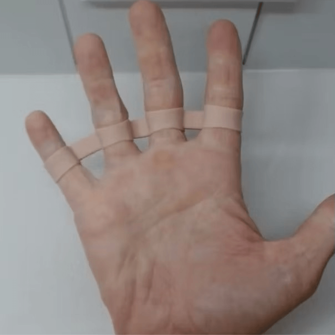 Bridgeflex splint on.png