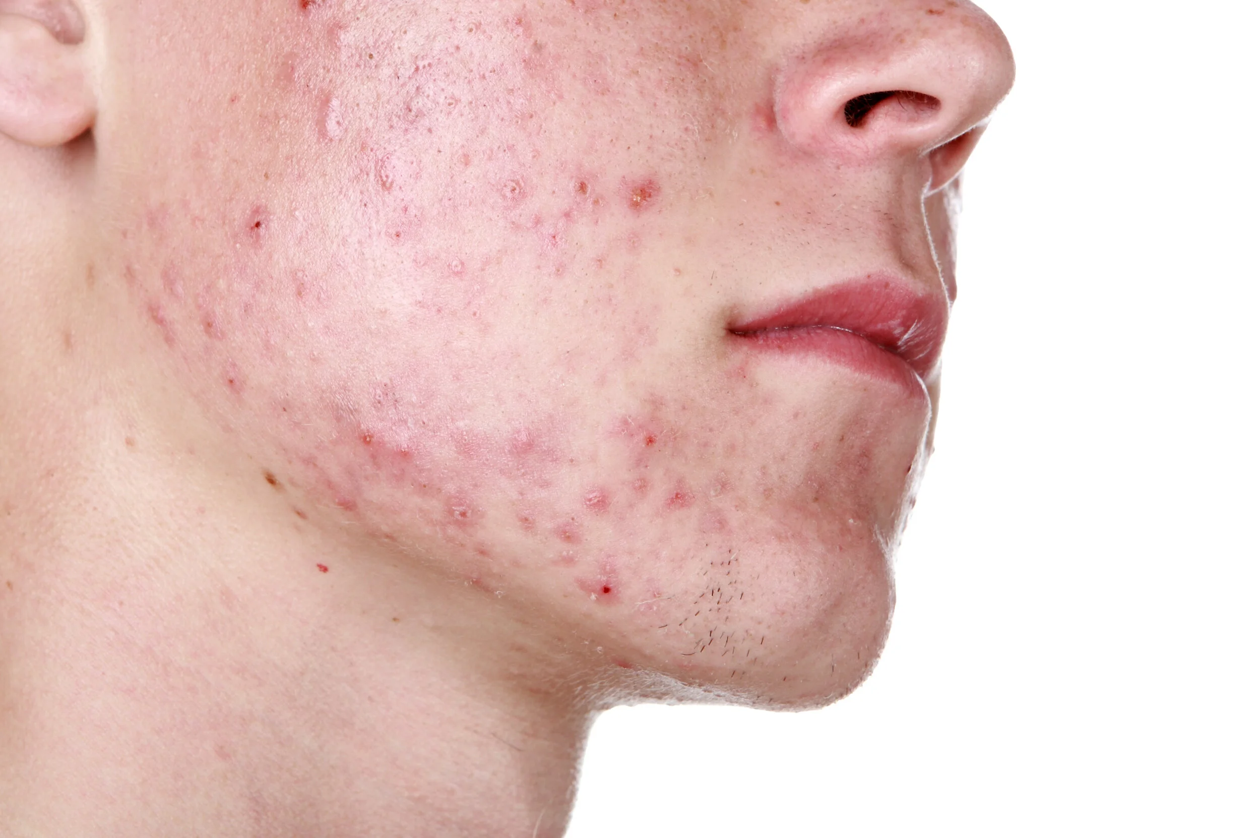 dermatologist for teenage acne near me