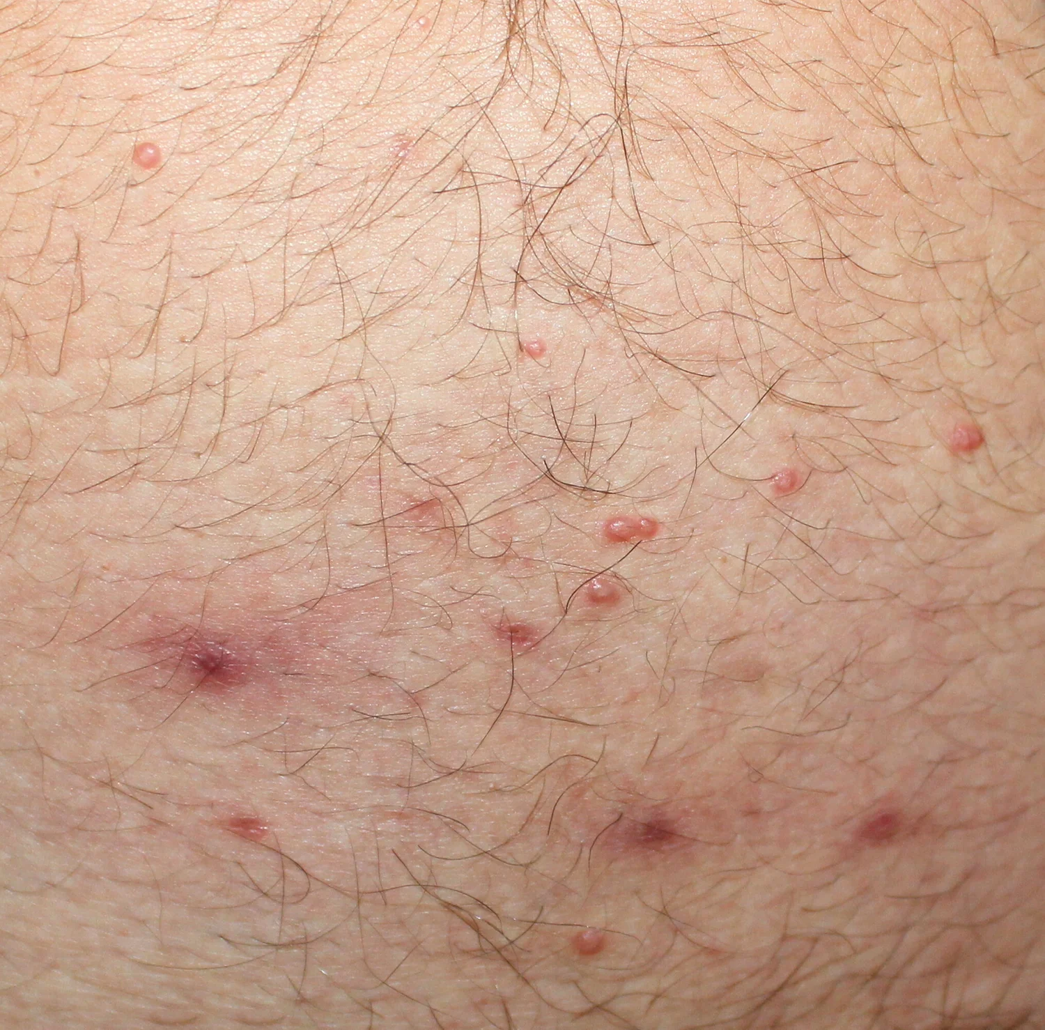 What Is Molluscum Contagiosum? — SSDP