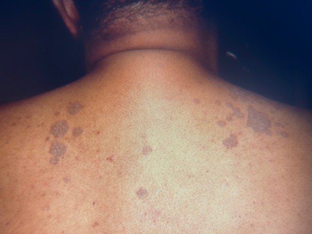 Tinea Versicolor: What You Should Know — SSDP