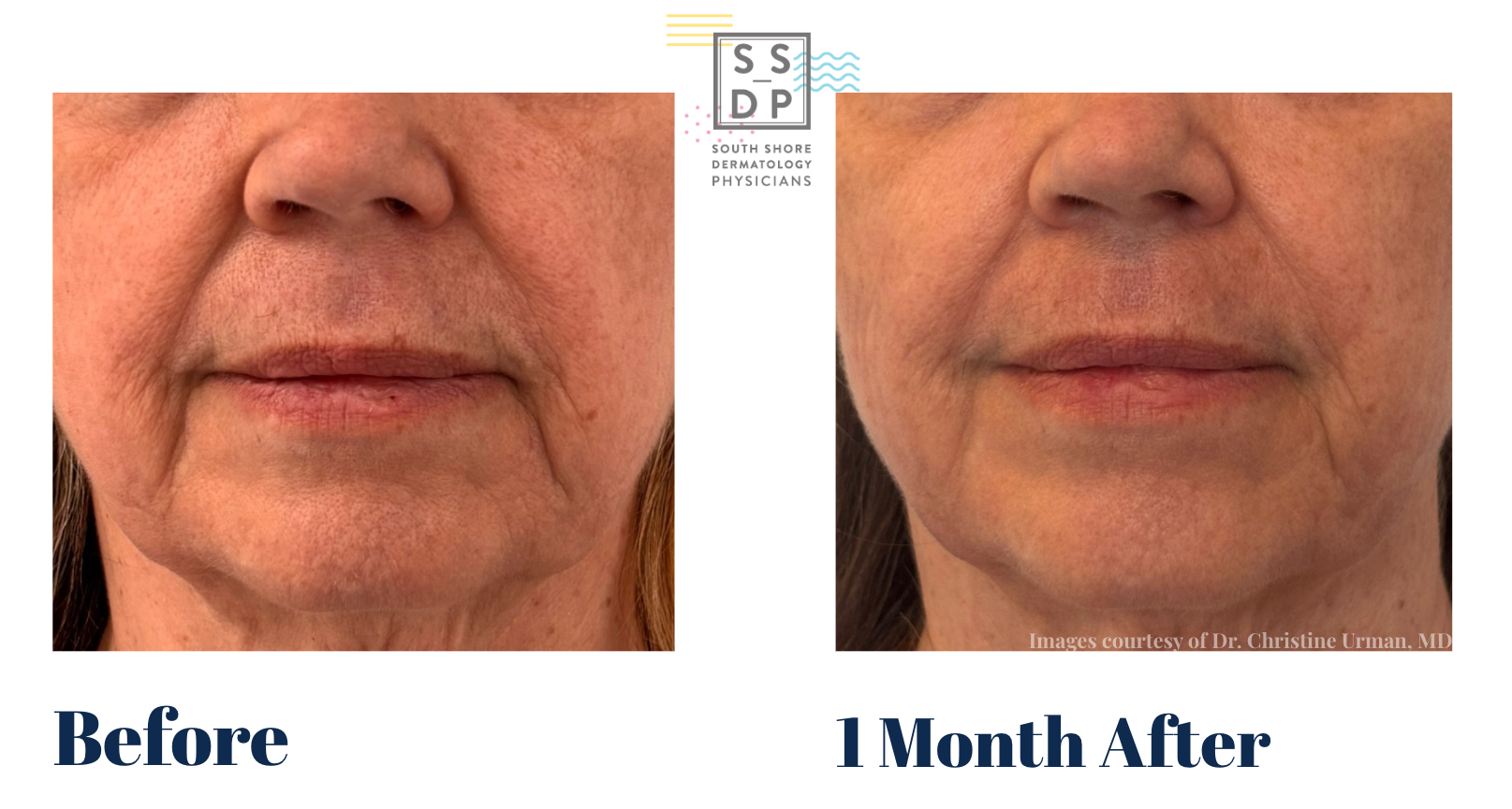 Before and after images of woman's face (frontview) - second image has less lines on her face