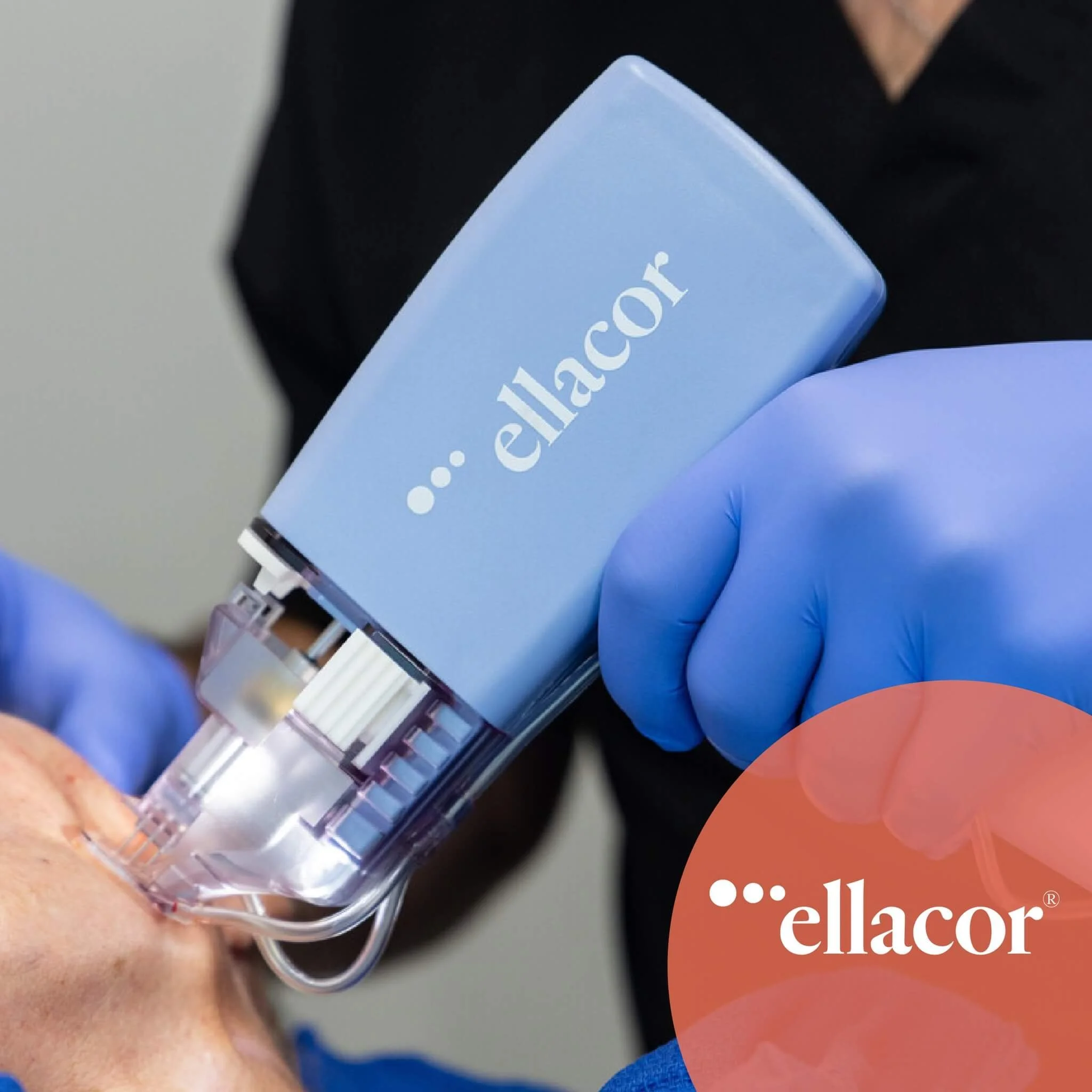 Micro-Coring® Procedure