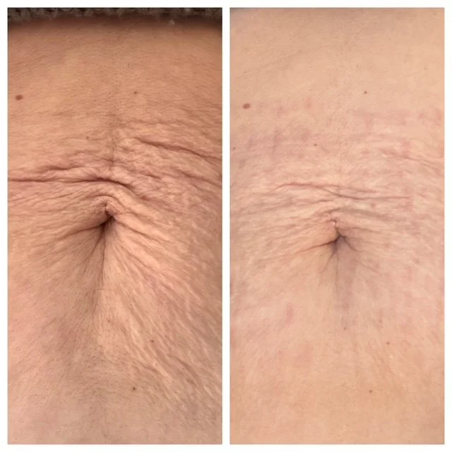 Before and after ellacor treatment on the abdomen of a patient - first image shows wrinkes and folds around belly button and after is much smoother