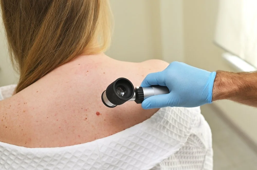 person's back with moles and hand holding a dermatoscope examining one mole