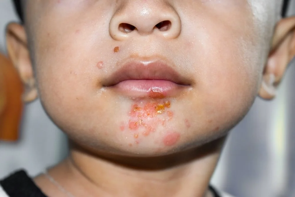 Impetigo Spot It Treat It Stop It SSDP