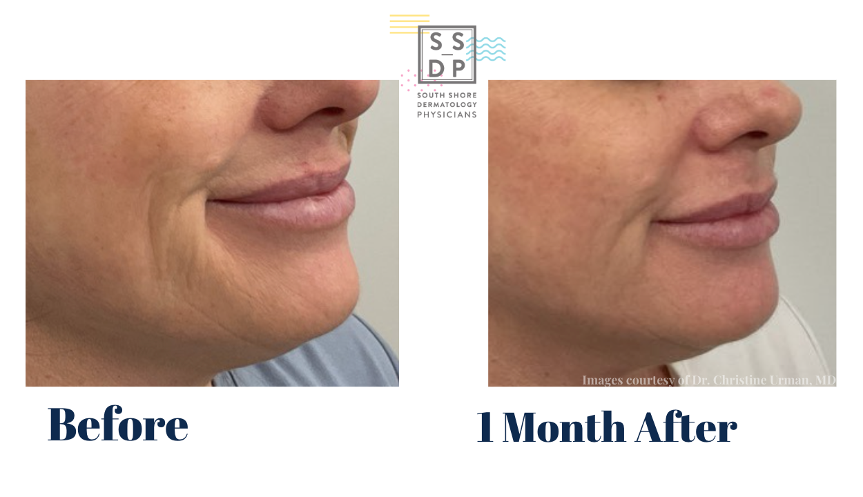 Before and after images of woman's face (sideview)- second image has less lines on her check