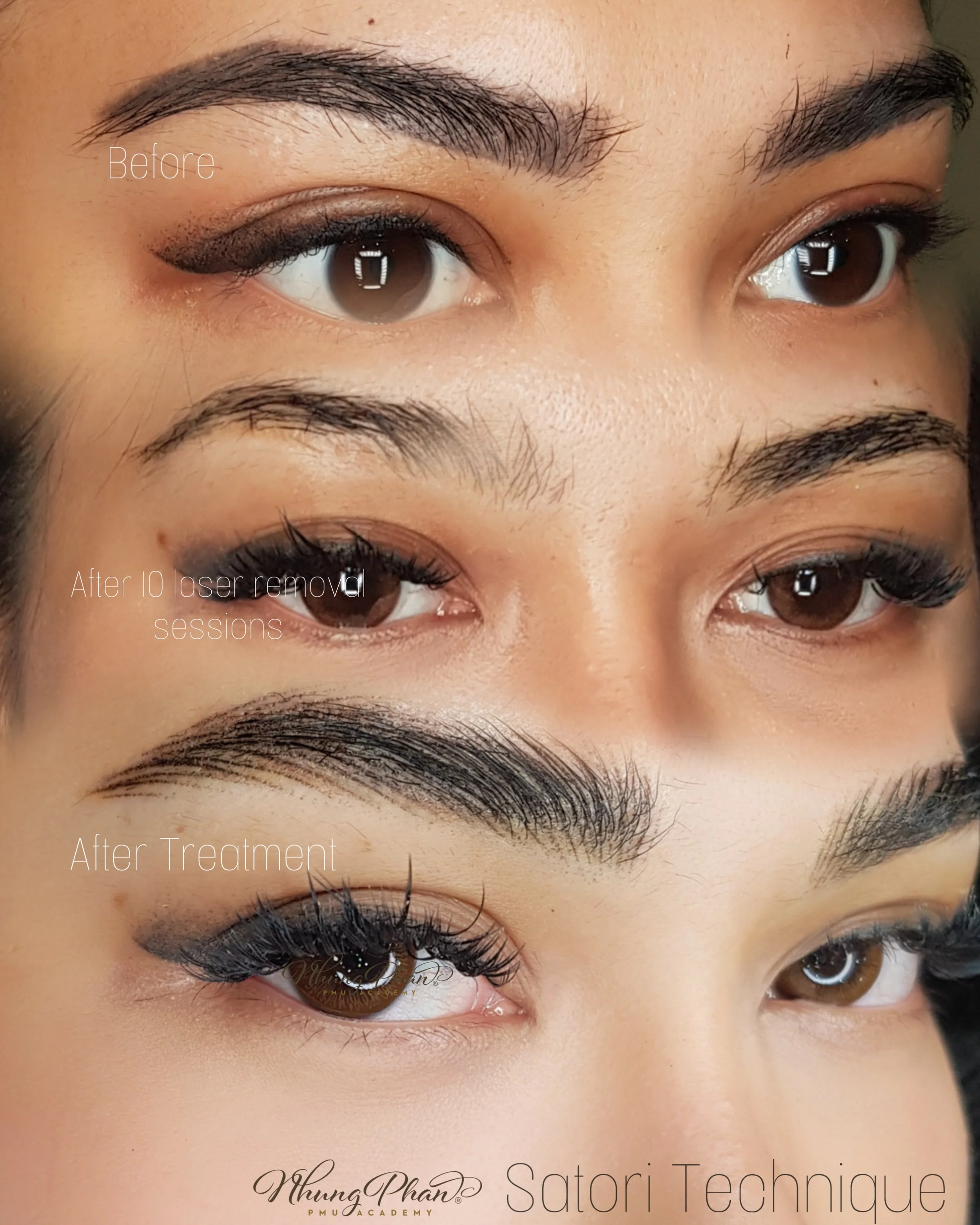 P_Satori Technique after 10 removal sessions.jpg