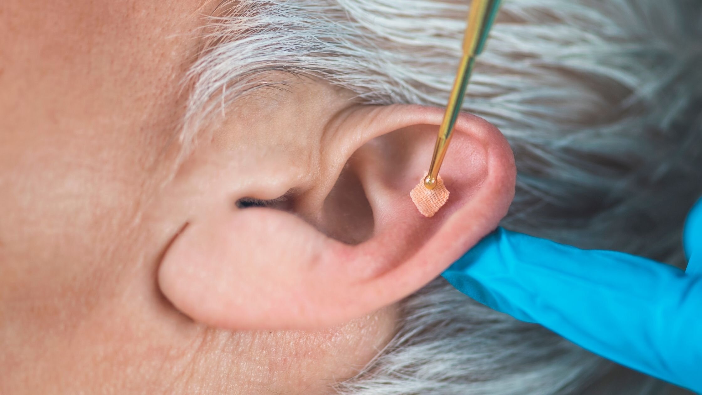 Acupuncture for Tinnitus: Exploring an Ancient Practice for Modern Relief