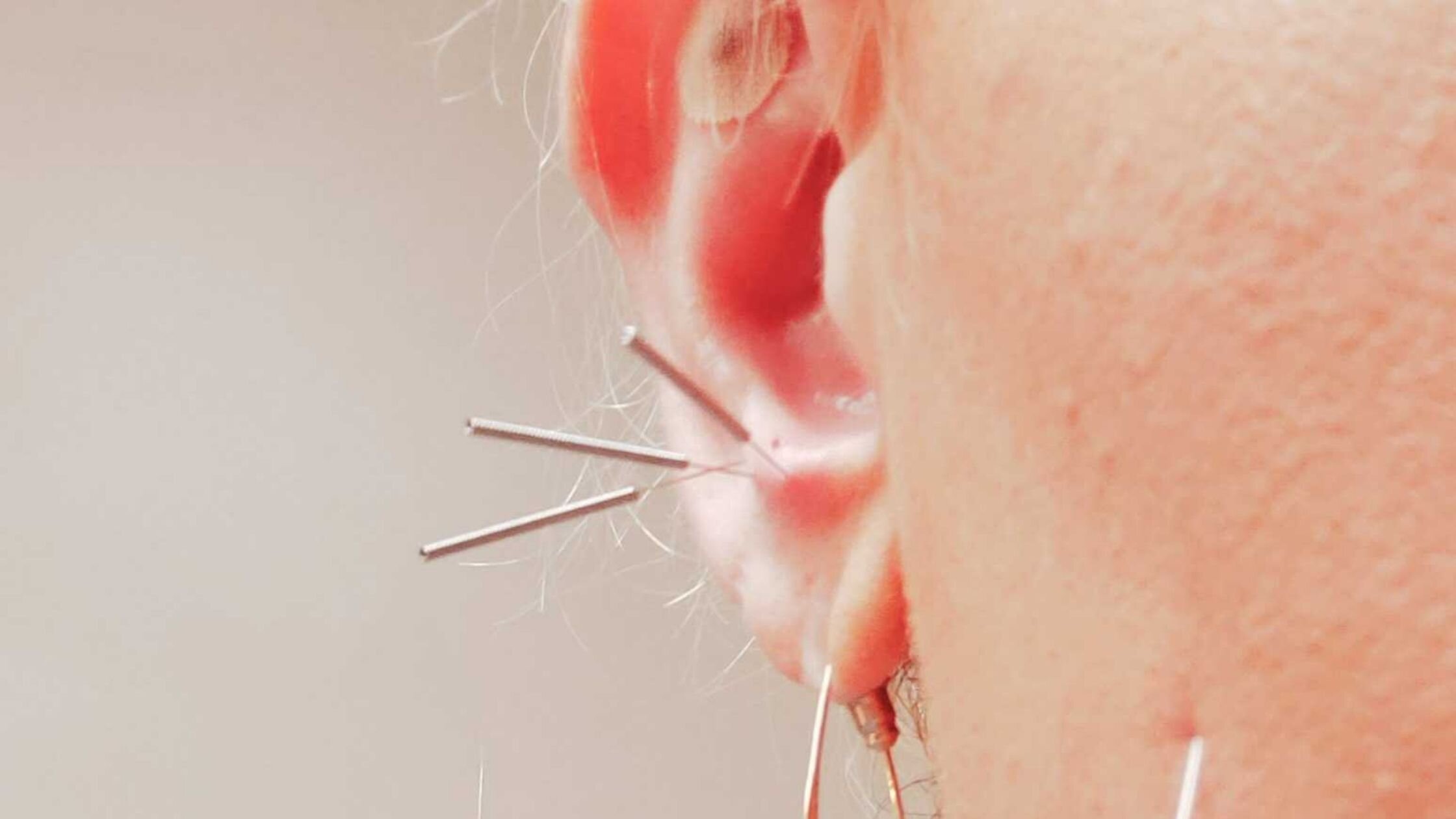 Acupuncture Treatment for Tinnitus - YouTube