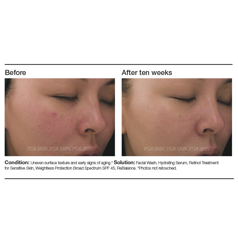 Retinol Treatment Sensitive Skin — WYSP