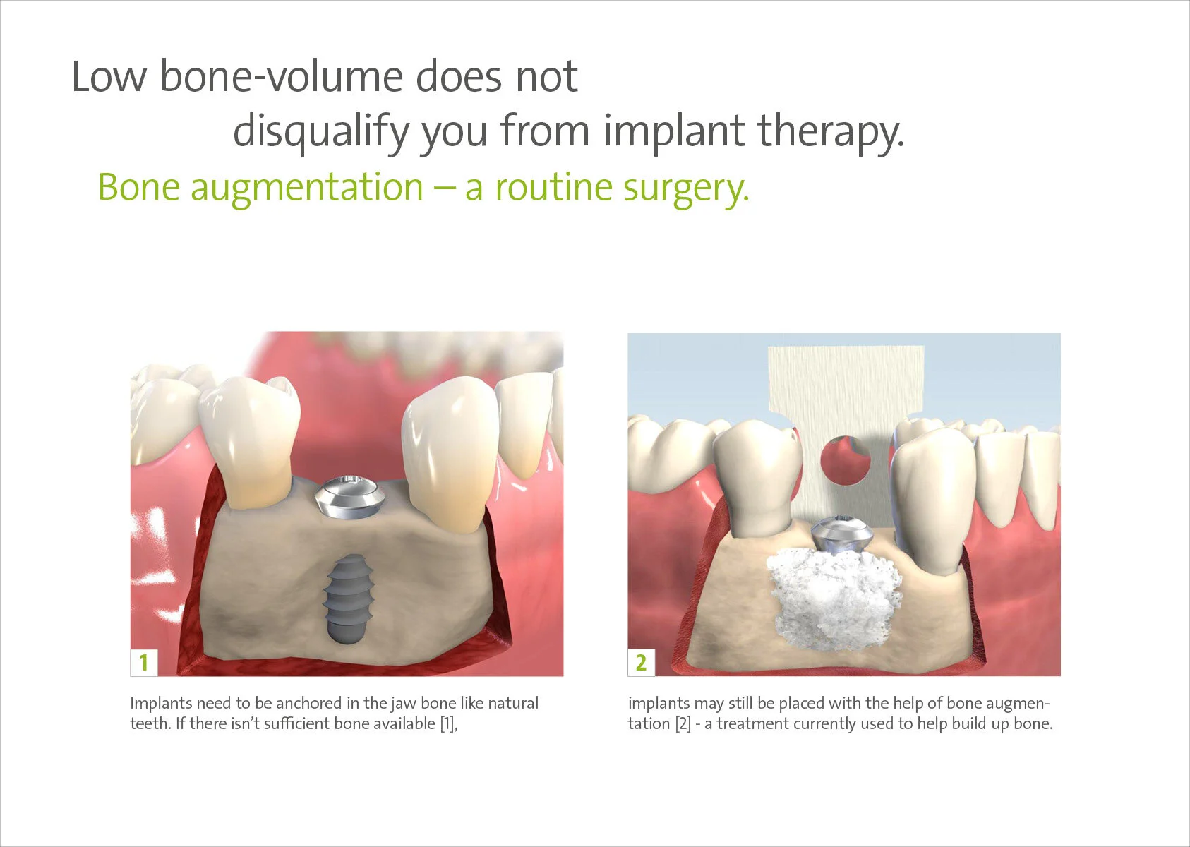 Bone augmentation — Kenyon Dental Implants