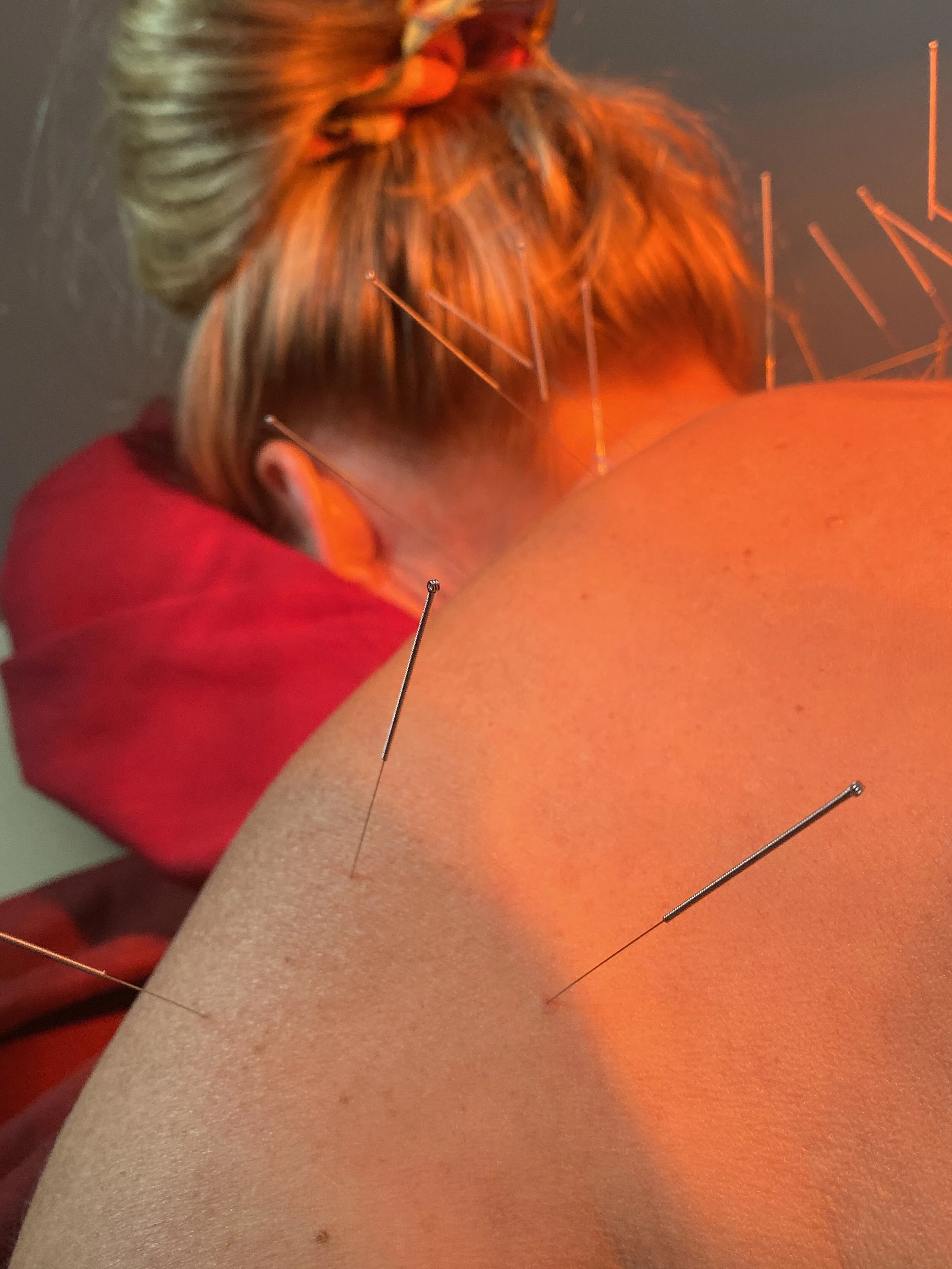 Acupuncture vs Dry Needling: Knowing the Difference 