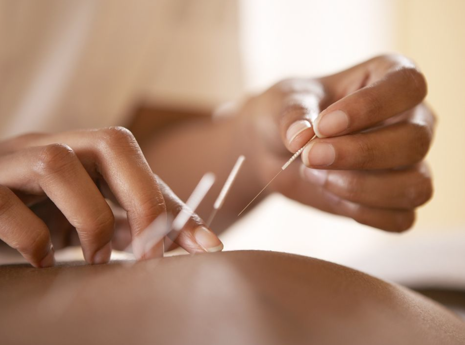 Dry Needling: The Complete Guide to the Benefits, Risks, Cost, and More