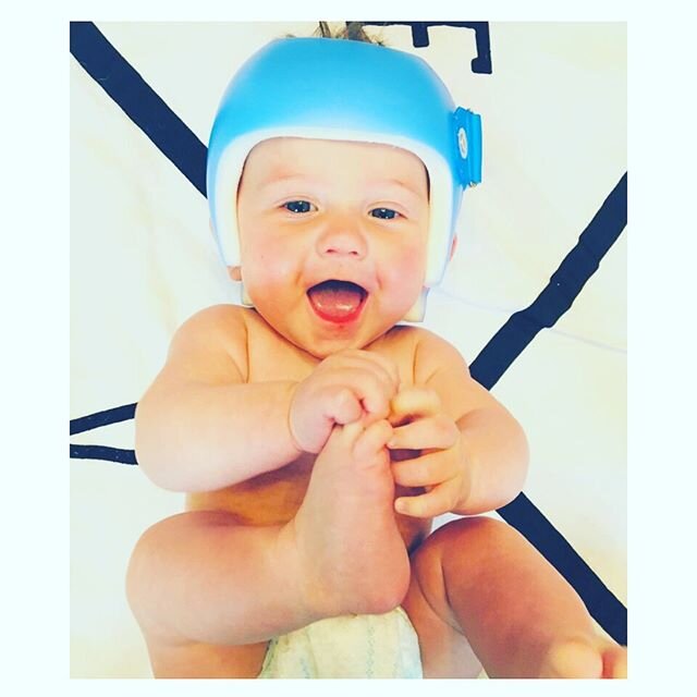 #plagiocephaly #brachycephaly #babyhelmet #helmethairdontcare #ptmamas #pediatricphysicaltherapy #torticollisawareness #torticollis #torticollisbaby