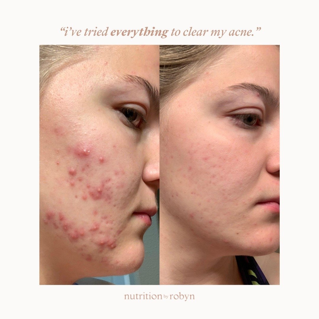 Healing your acne can feel like an uphill battle, but it doesn't have to be. You need an approach that targets the root causes (yes, plural) of acne. That&rsquo;s exactly what we teach you inside our Clear Skin Lab program. ⁠
⠀⠀⠀⠀⠀⠀⠀⠀⠀⁠
This self-pac