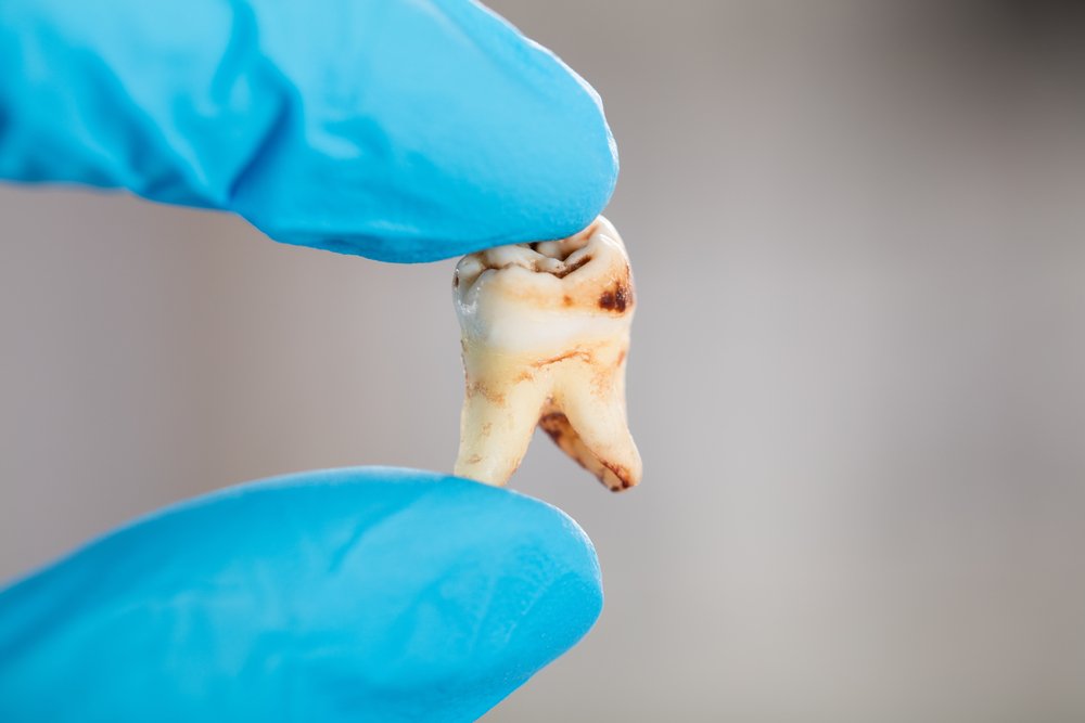 Tooth Decay or Cavities: A Dentist's Guide