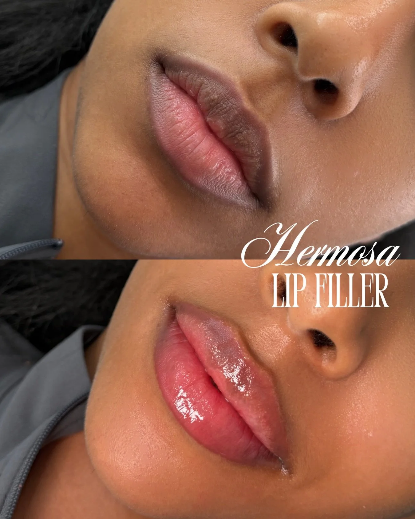 JUICY LIPS FOR LIFE 👀💋 
Booking with @injectortifff 

Nurse Tiff🤍
Half Syringe $315
Full Syringe $515
Botox $8/unit

Promo valid until the end of February💋❤️

Full syringes may be split, but must be used within 2 months Lip flips are excluded fro