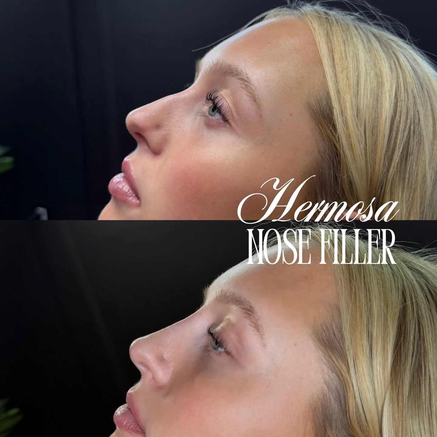 NON SURGICAL NOSE JOB BY HERMOSA ✨⭐️
@injectorjoan 

(Must be a good candidate for nose filler, excluded to  rhinoplasty patients) 

Booking with Nurse joan for all three locations available online💌