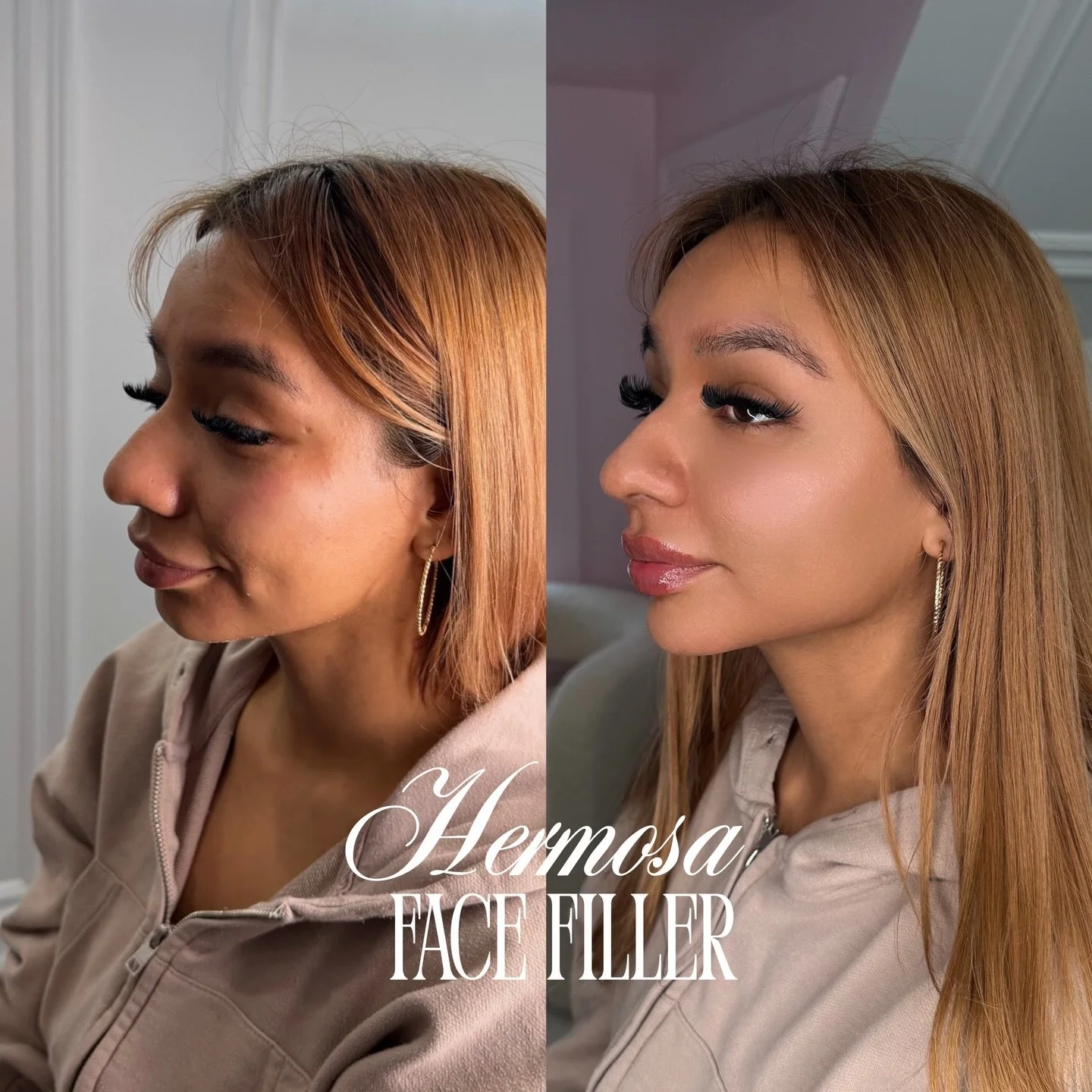 HERMOSA FULL FACE FILLER TRANSFORMATION ⭐️💛

JAWLINE, CHIN, CHEEK, LIPS IN ONE SESSION ✨

Booking available online at all locations 🌟